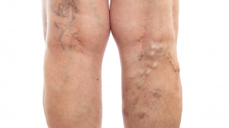 Recognizing the Signs of Deep Vein Thrombosis