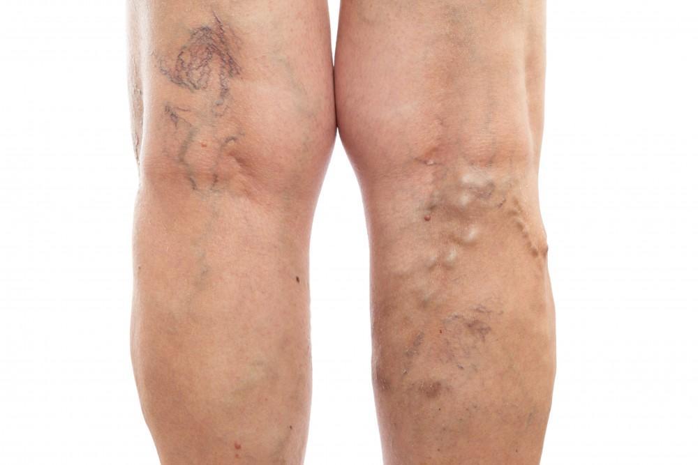Recognizing the Signs of Deep Vein Thrombosis